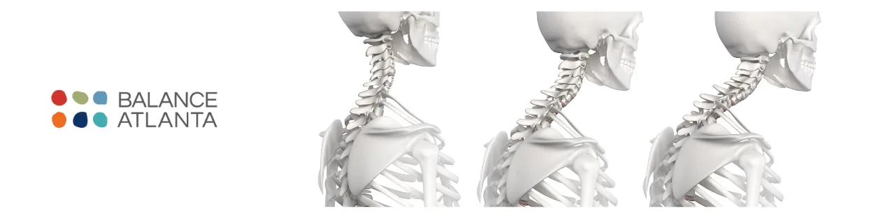 Balance Atlanta logo beside three side-view skeletal illustrations of the neck and upper back showing varying cervical alignment.
