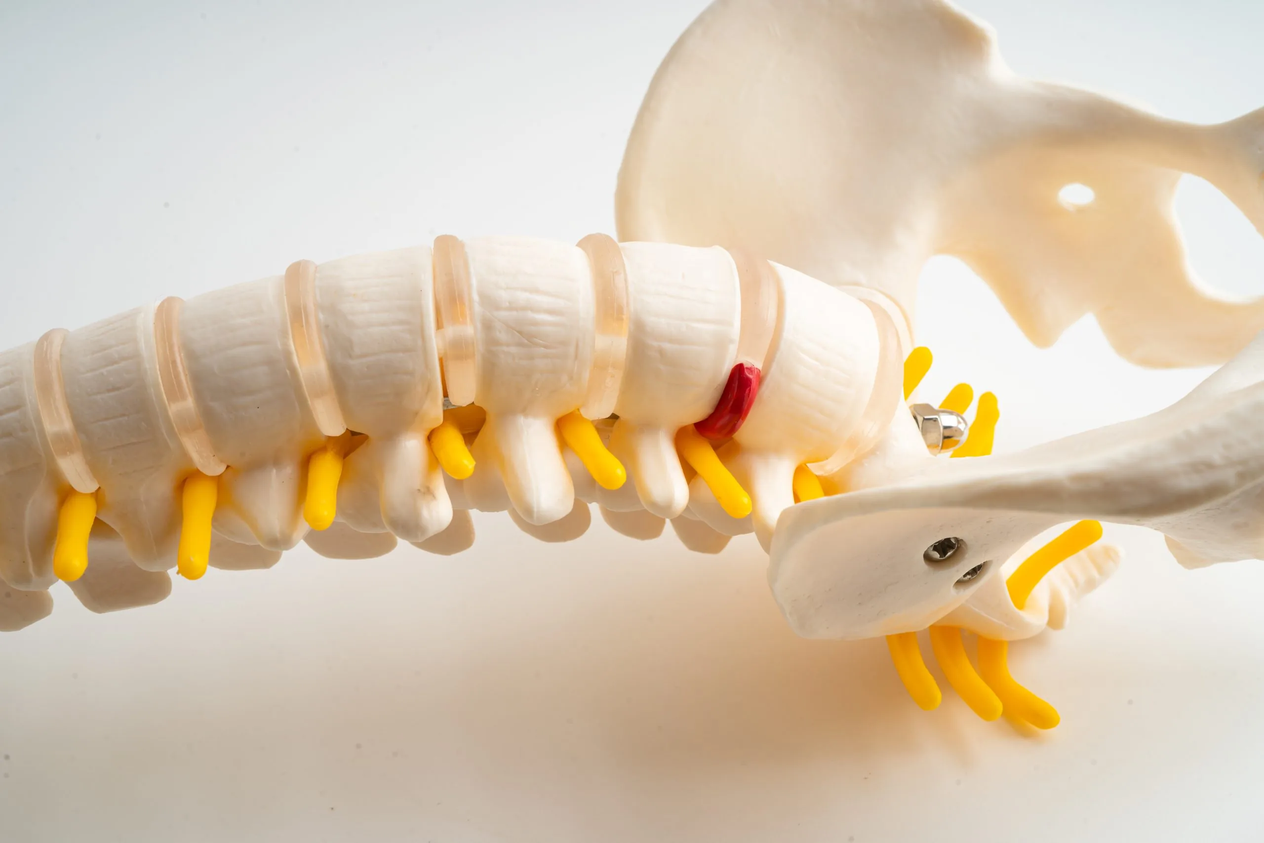 anatomical spine model with a red herniated disc and yellow nerve roots