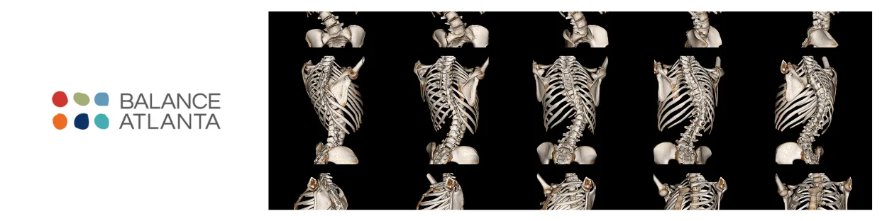 Multiple 3D skeletal/CT views showing lateral curvature of the spine on a black background, with the Balance Atlanta logo to the left.