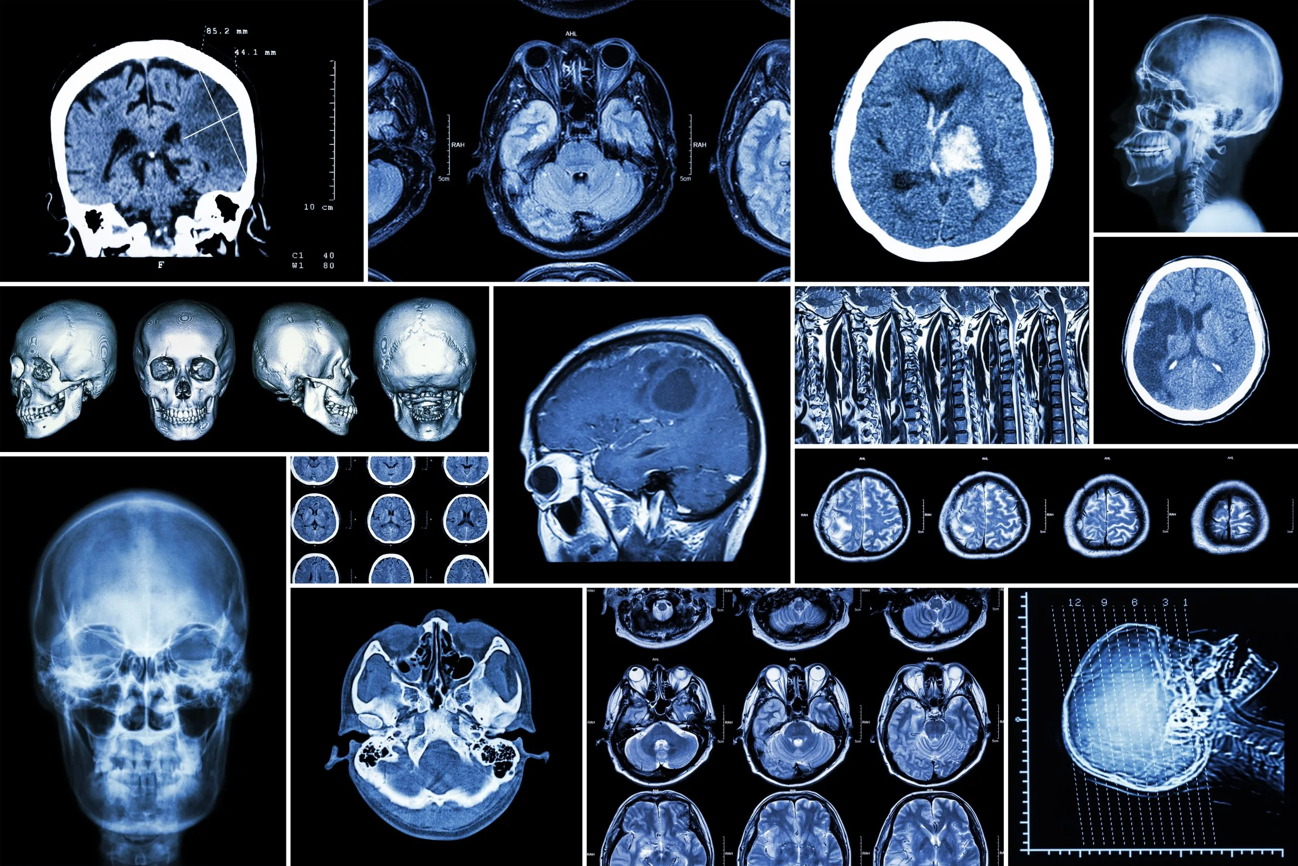 Multiple diagnostic brain and skull images arranged in a collage, showing axial and sagittal CT and MRI scans and skull x‑rays.