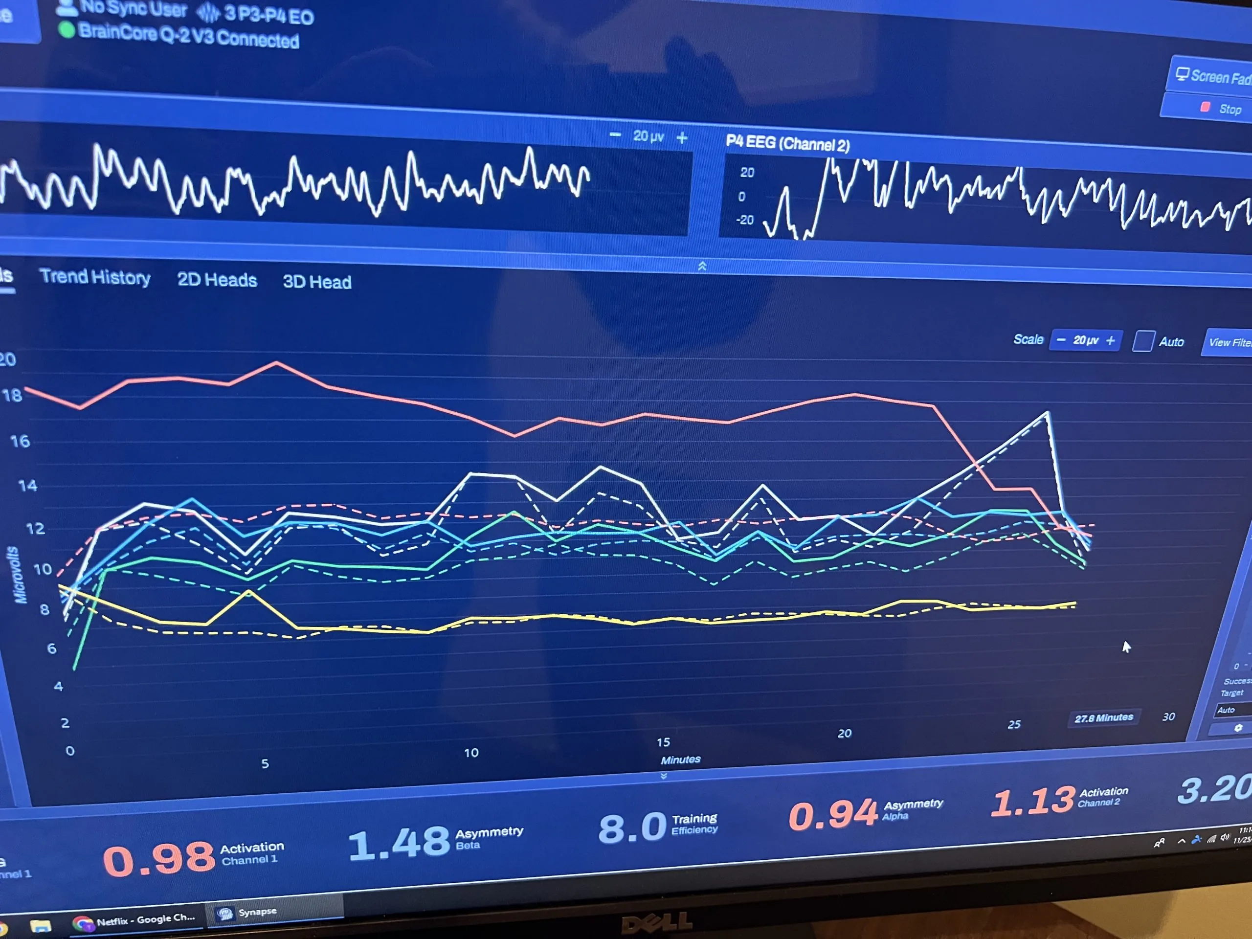 EEG waveforms and multicolored trend lines displayed on a monitor, showing brain activity metrics used in braincore therapy for autism.