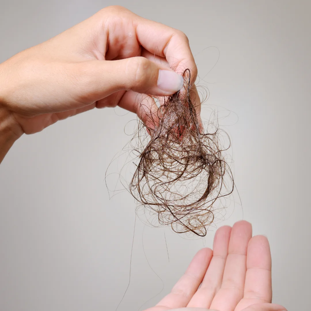 Hand holding a tangled clump of shed hair above an open palm, illustrating hair loss associated with autoimmune conditions