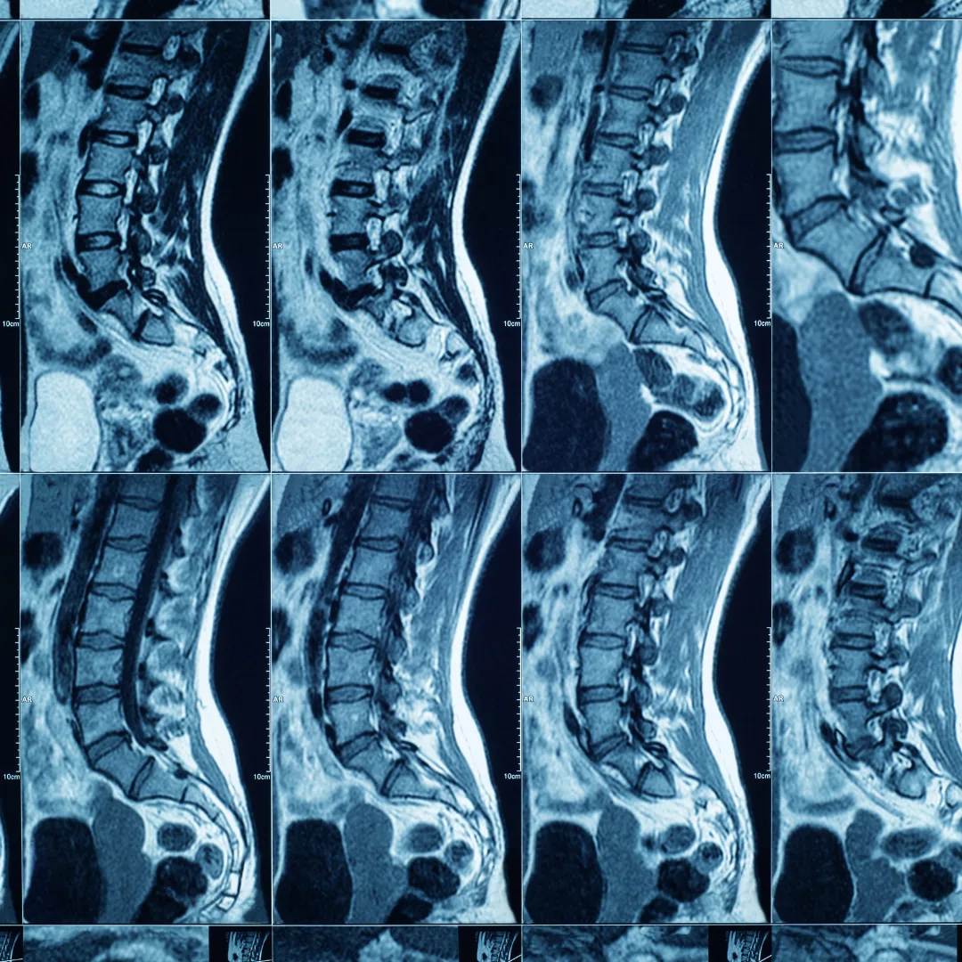 Series of sagittal MRI images showing the lumbar spine and lower vertebrae