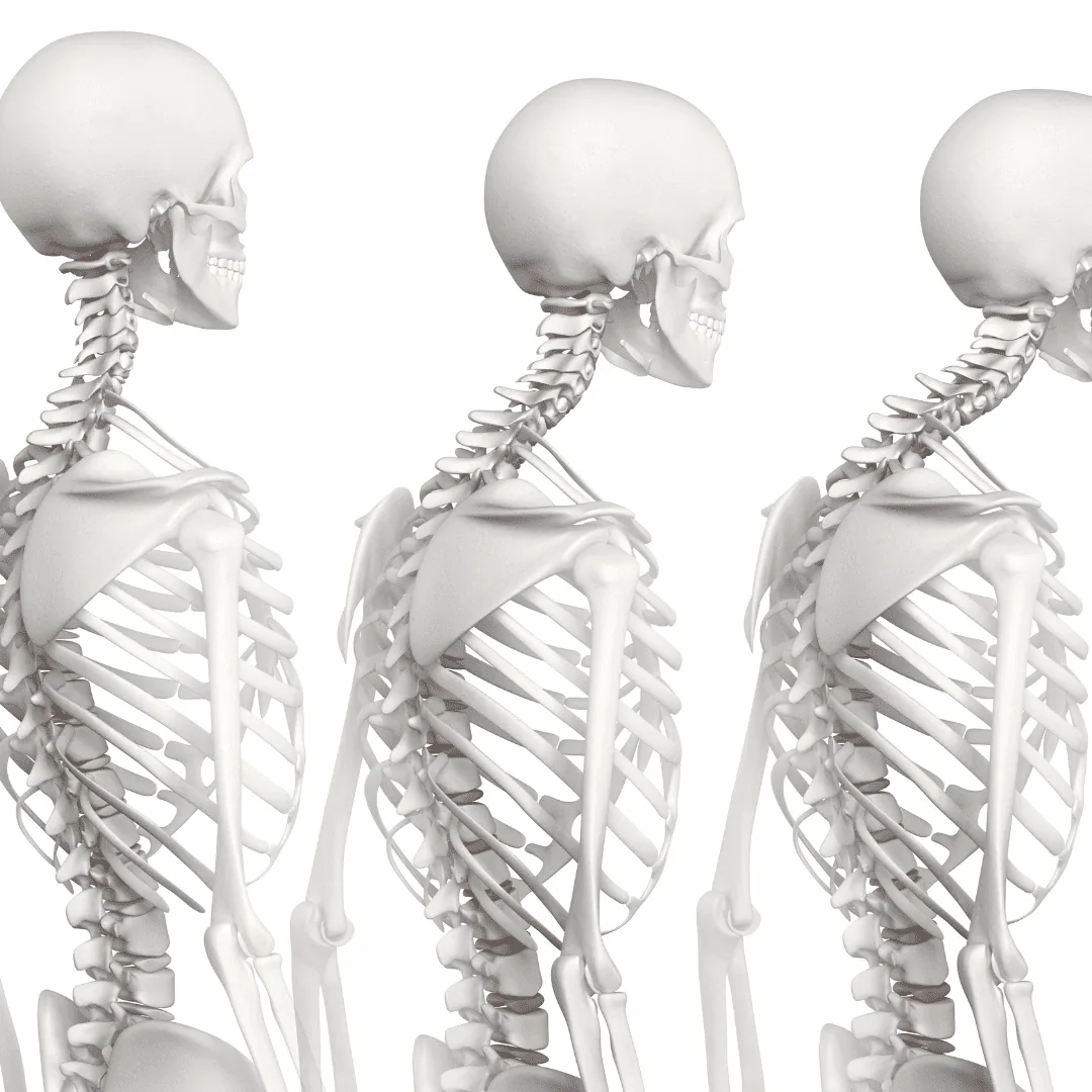 Three human skeletons in profile view, displaying the skull, spine, and ribs.